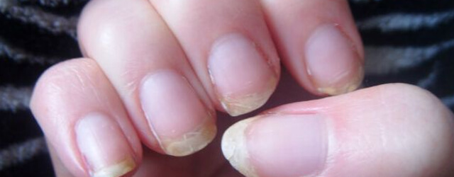 слабость и расслоение ногтей